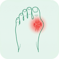 Bunions