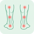 Overpronation
